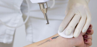 Trwałe usuwanie tatuażu